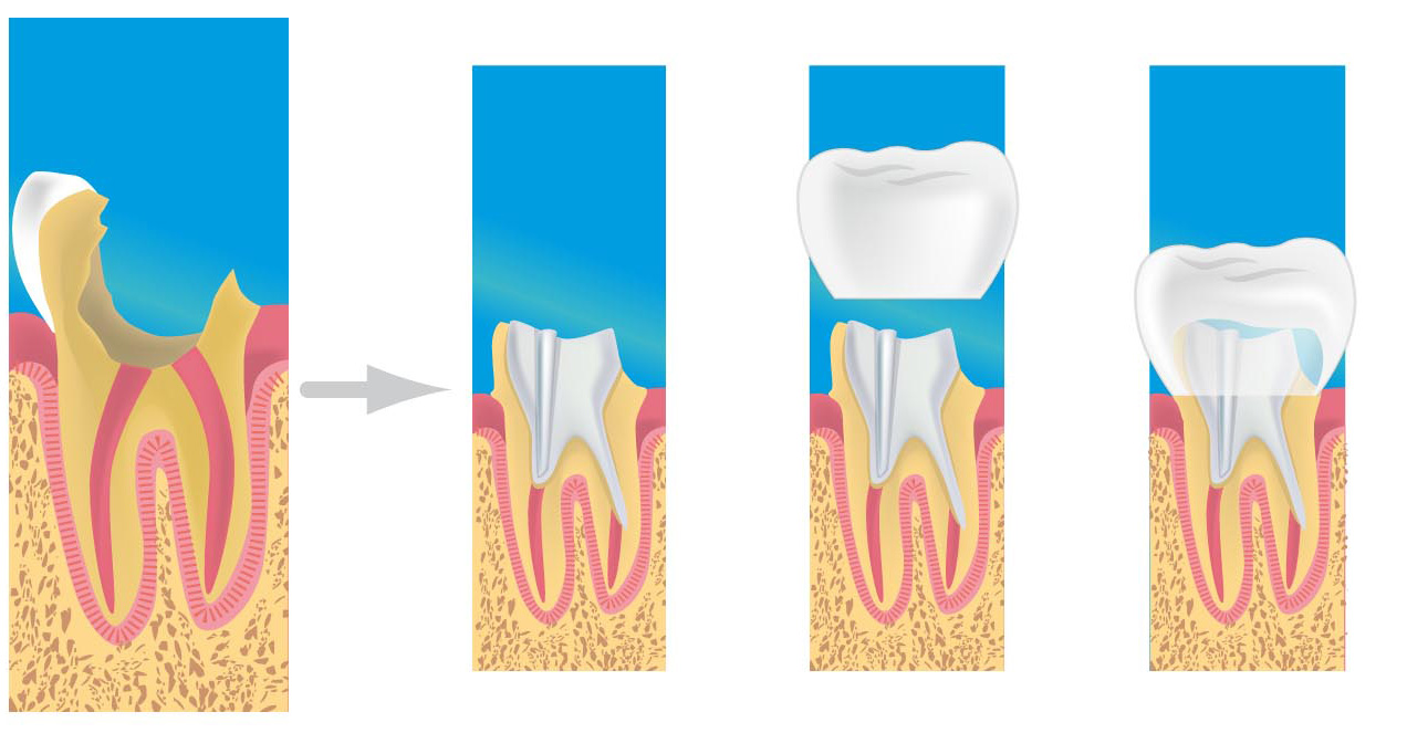 prothèse dentaire Le havre