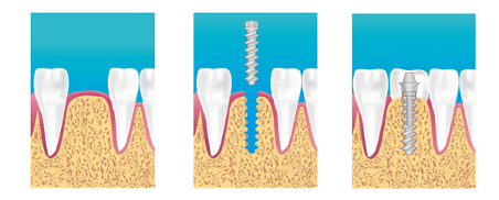 Spécialiste implant dentaire Le Havre